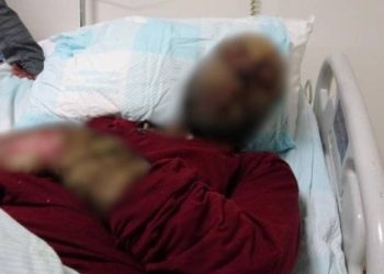 Milyonda 3 kişide görülen hastalık Türkiye’de: Yüzü tanınmaz hale geldi