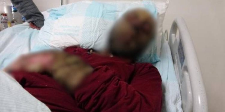 Milyonda 3 kişide görülen hastalık Türkiye’de: Yüzü tanınmaz hale geldi