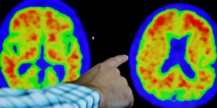 Araştırma: Alzheimer'a karşı yeni umut Viagra olabilir