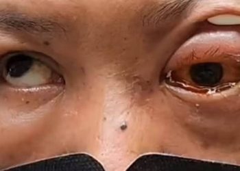 İçki içip yüzüstü uyuyan kişi, bir gözü kör olarak uyandı!