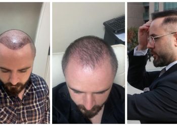 Mahkeme, başarısız saç ekiminde ücret iadesine karar verdi