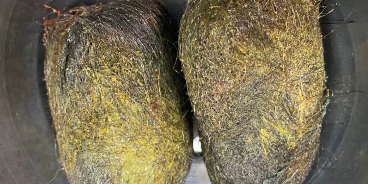 Osmaniye'de mide ve bağırsağından 2 kilogram kıl çıktı!