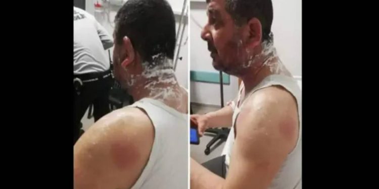 Hatay'da Demokrat Partili adayın yüzüne asit fırlatıldı