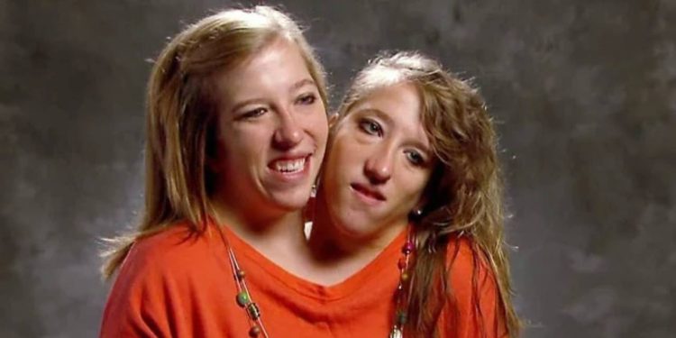 Yapışık ikizlerden Abby Hensel, ABD'li bir savaş gazisiyle evlendi