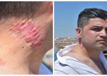 Lazer tedavisi sonrası 'yanık izi belirginleşti' suçlaması