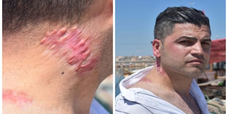 Lazer tedavisi sonrası 'yanık izi belirginleşti' suçlaması