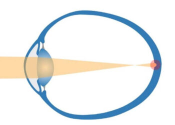 Çocuklarda miyopi salgınına dikkat: ‘Genellikle 6 ila 12 yaşları arasında gelişiyor’