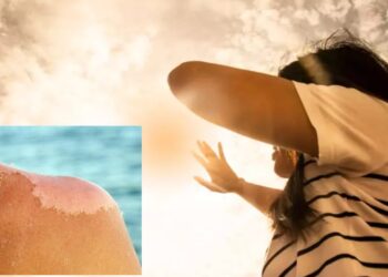 Güneş yanıklarına dikkat: Kalıcı hasar bırakabilir