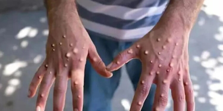 En Tehlikeli Varyant! Ölümcül Virüs Temasla Bulaşıyor