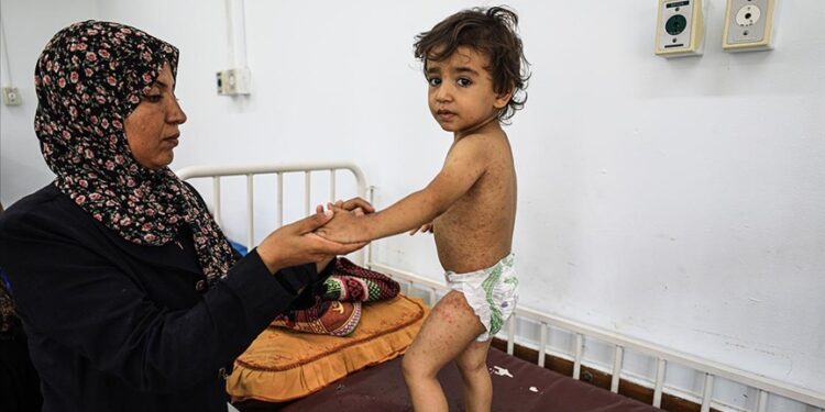 Gazze Şeridi’nin birçok bölgesinde cilt hastalıkları yaygınlaşıyor