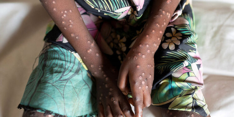 ACİL DURUM | Dünya Sağlık Örgütü, maymun çiçeği salgını nedeniyle ‘küresel acil durum’ ilan etti