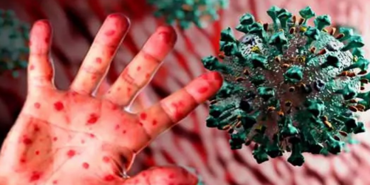 Adım Adım Maymun Çiçeği Virüsü Haritası: Hangi Ülkede Kaç Vaka Ortaya Çıktı