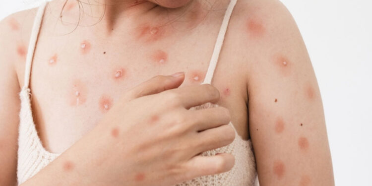 Ankara İl Sağlık Müdürlüğü’nden “maymun çiçeği karantinası” açıklaması