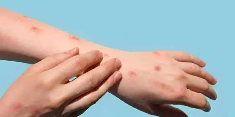 DSÖ'den Korkutan Yeni Varyant Uyarısı! 'Maymun Çiçeği Virüsünde Esas Tehlike...'