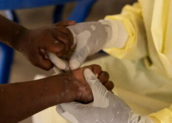 DSÖ'den Maymun Çiçeği Virüsü Açıklaması