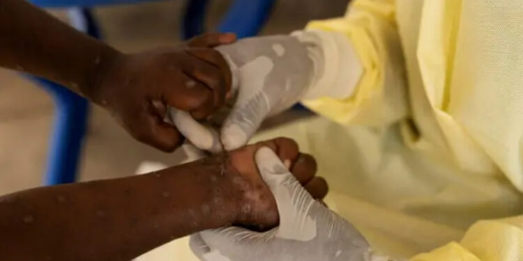 DSÖ'den Maymun Çiçeği Virüsü Açıklaması