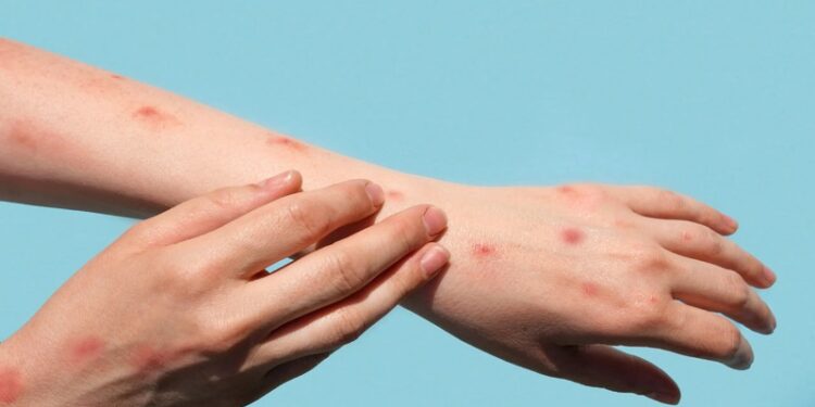 Dünya Sağlık Örgütü, maymun çiçeği salgını nedeniyle 'küresel acil durum' ilan etti