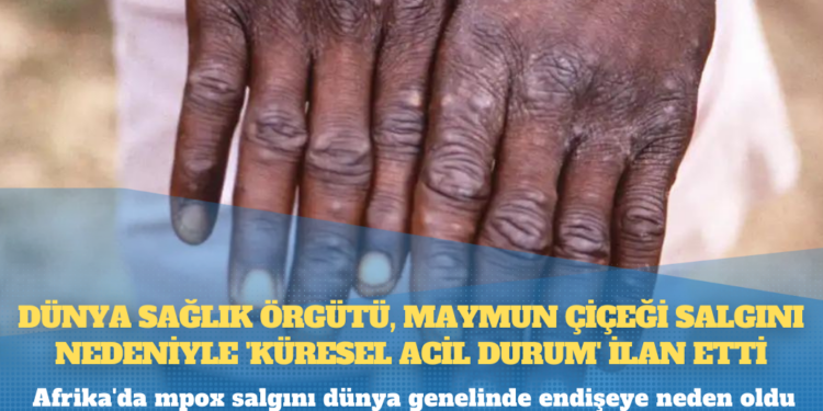 Dünya Sağlık Örgütü, maymun çiçeği salgını nedeniyle ‘küresel acil durum’ ilan etti
