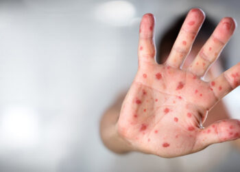 Dünyada Maymun Çiçeği Alarmı! Türkiye'de Maymun Çiçeği Virüsü Var mı? Sağlık Bakanı Kemal Memişoğlu Açıkladı