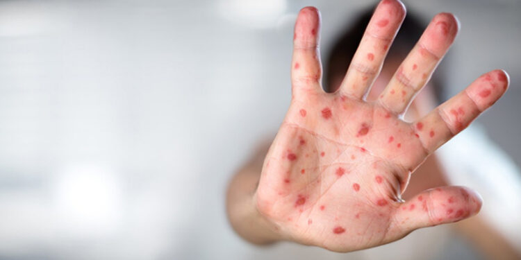 Dünyada Maymun Çiçeği Alarmı! Türkiye'de Maymun Çiçeği Virüsü Var mı? Sağlık Bakanı Kemal Memişoğlu Açıkladı