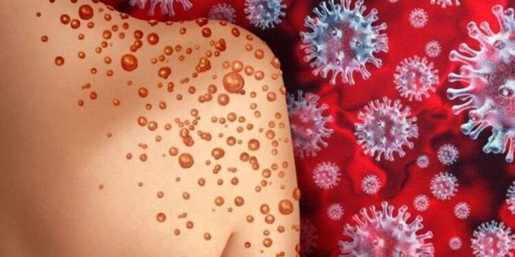 İstanbul İl Sağlık Müdürü’nden maymun çiçeği açıklaması