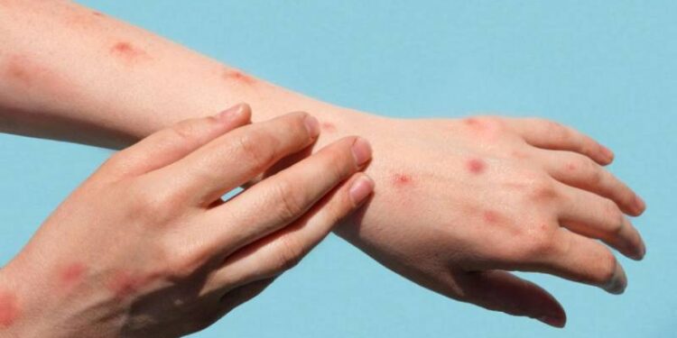 İstanbul'da "M çiçeği" görüldü mü? İl Sağlık Müdürü'nden "M çiçeği" ve "Batı Nil virüsü" hakkında açıklama