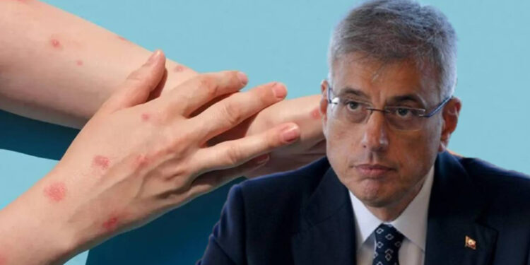 Maymun Çiçeği Türkiye'de Görüldü Mü? Sağlık Bakanı Memişoğlu'ndan Açıklama