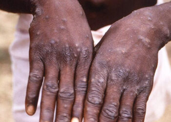 Maymun Çiçeğinde Vaka Sayısı Katlanıyor! Kongo Demokratik Cumhuriyeti'nde 610 Kişi Öldü