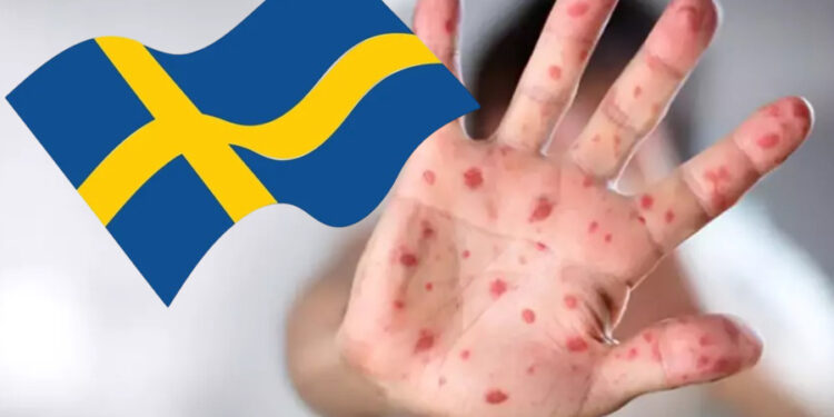 Maymun çiçeği hastalığı Avrupa’ya sıçradı: İsveç ilk vakayı doğruladı