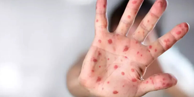 Sağlık Bakanlığı’ndan maymun çiçeği hastalığı rehberi