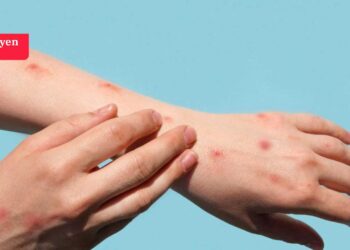 TTB Başkanı Azap'tan 'maymun çiçeği' açıklaması: Şu an için kısıtlama ve ek tedbire gerek yok