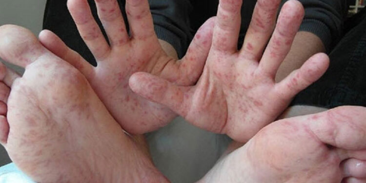 Isparta'da Öğrencilerde El, Ayak, Ağız Hastalığı Belirdi: 11 Kişi Tedavide