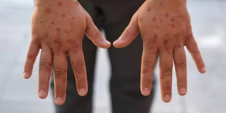 Maymun Çiçeği Kontrolden Çıktı! Kıtanın 4 Bölgesine Yayıldı