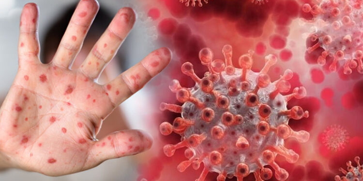 Uzmanı Uyardı, Bunlara Dikkat Edin! Çocuklar İçin Maymun Çiçeği Riski