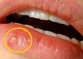 Dudaktaki Uçuk Nasıl Geçer?