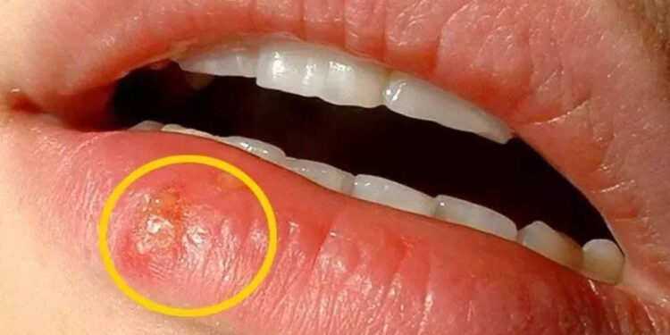 Dudaktaki Uçuk Nasıl Geçer?