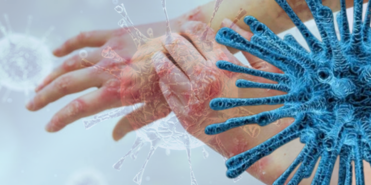 Türkiye Alarmda, Vakalar Her Gün Artıyor: Kaşıntıyı Hafife Almayın