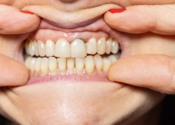 Uzmanı Açıkladı! Fazla Antibiyotik Kullanmak Dişlerde Bu Soruna Neden Oluyor