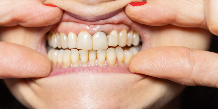 Uzmanı Açıkladı! Fazla Antibiyotik Kullanmak Dişlerde Bu Soruna Neden Oluyor