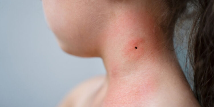 ABD'den Sonra Türkiye'ye de Geldi! Keneden Bulaşıyor, Beyne Zarar Veriyor