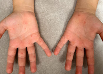 Aileler Bu Hastalığı Hafife Almayın!