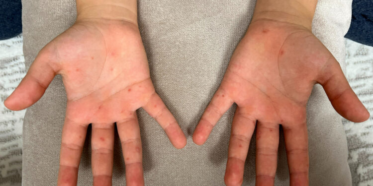 Çocuğunuzda Bu Belirtiler Varsa Sakın Hafife Almayın!