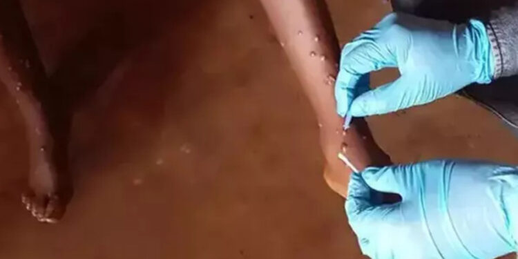 DSÖ’den Maymun Çiçeği aşısına acil kullanım onayı