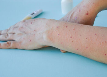 Nijerya M Çiçeği Aşılamasına Başladı! Öncelik O Kişilere Veriliyor