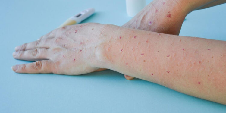 Nijerya M Çiçeği Aşılamasına Başladı! Öncelik O Kişilere Veriliyor