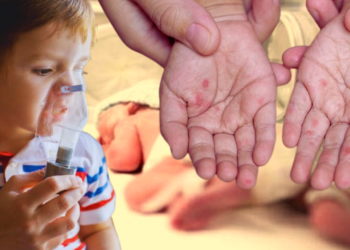 Vakalar Patladı, Yeni Salgın Kapıda! Kovid'den Daha Hızlı Bulaşıyor, Yıllar Sonra Yeniden Hortladı