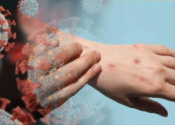 Kosova'da Maymun Çiçeği Alarmı! İlk Vaka Tespit Edildi