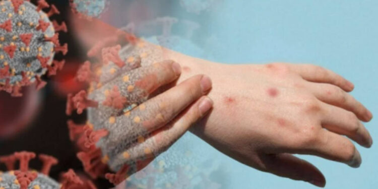 Kosova'da Maymun Çiçeği Alarmı! İlk Vaka Tespit Edildi