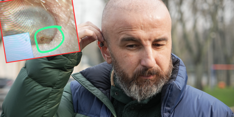 Saç Ektirmek İçin Gitti, Kulak Zarı Patladı