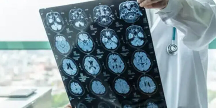 Bunamanın ilk belirtisi 11 yıl önce ortaya çıkıyor: Hızlı kilo kaybı ve yüksek seviyedeki iyi kolesterol…